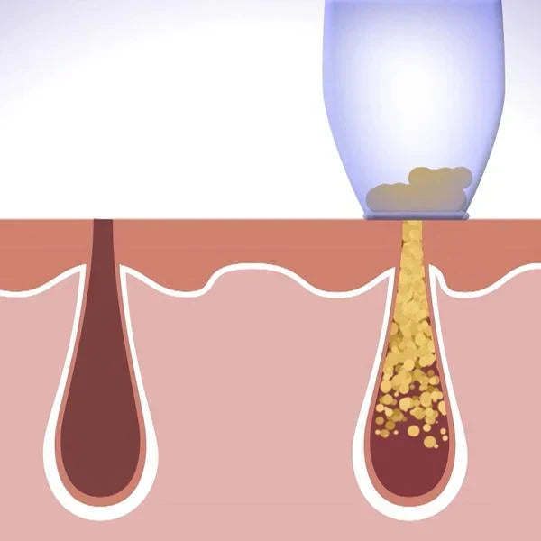 DERMASUCTION™ | PIMPLE & BLACKHEAD REMOVER